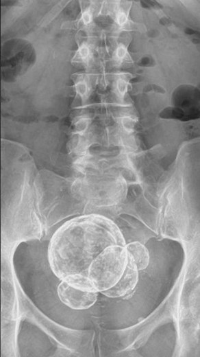 Benign Uterine Fibroids or Leiomyomas
