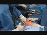 FDA Approved Contained Tissue Extraction • Video • MEDtube.net