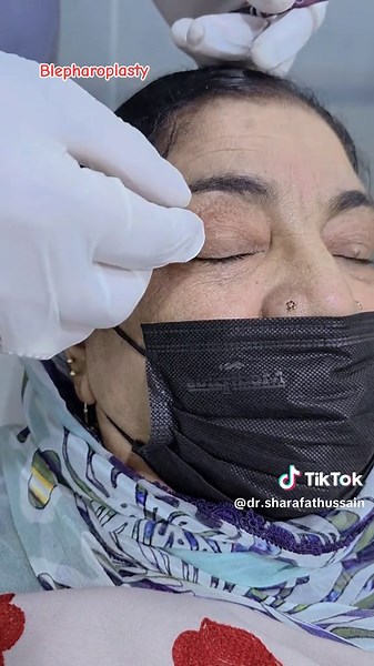 Blepharoplasty: Eyelid Surgery Explained