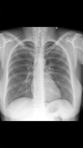 Chest X-ray Findings Bronchitis Clues! #radiologyShort