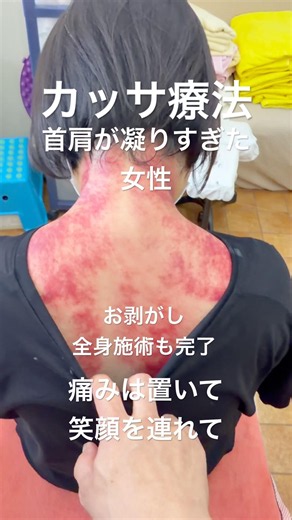 カッサ療法で強烈な肩こりにアプローチ！全身施術も入れて解決！