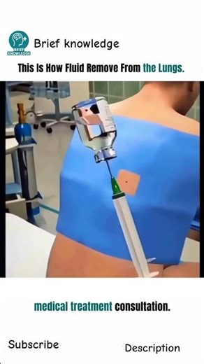 REMOVE FLUID From Lungs | Removing Fluid From the Lungs | Life-Saving Procedure