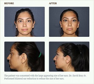 Macrotia Repair Torrance CA - Ear Reduction Surgery Torrance