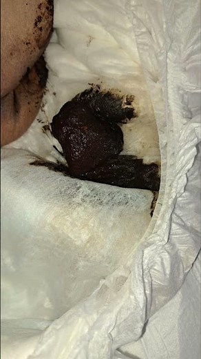 How Melena looks like- black, tarry, and foul-smelling stools, which result from upper GI bleeding.