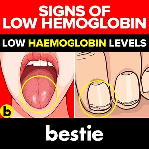 82K views · 639 reactions | In today’s video, we will discuss symptoms of low haemoglobin. Shortness of breath, constant fatigue, restless legs, dry hair. | Bestie | Facebook