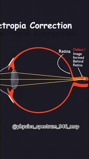Your Retina Problem Solved By This Lens 💡 | Human Eye Physics #neet #Optics