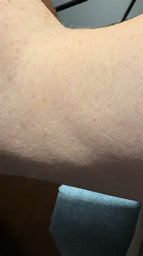 Muscle Twitches: Understanding ALS Fasciculations