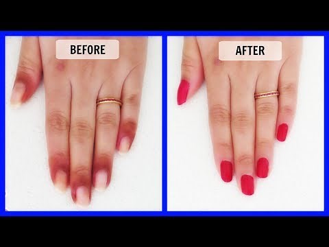 How to get rid of dark skin around the nails in just 7 Days