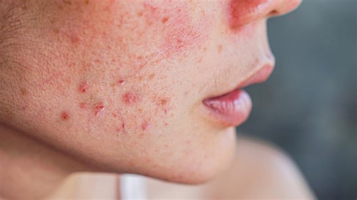 Kann Vitamin C Hautausschlag verursachen?