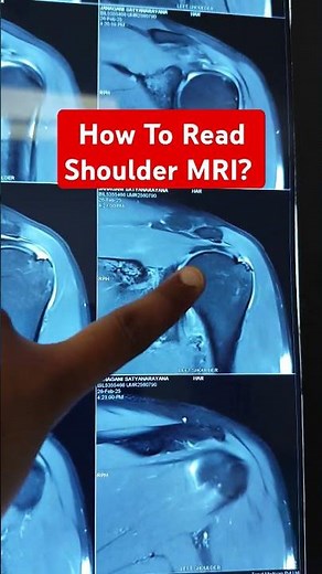 How To Read Shoulder MRI? Dr Sai Chandra MBBS DNB Ortho Hyderabad