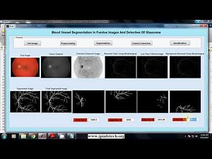 Blood Vessel Segmentation in Fundus Images and Detection of Glaucoma | Matlab Final Year Project