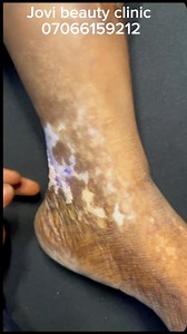 Scar camouflage tattoo is an advanced micropigmentation or paramedical tattoo procedure using colour pigments to blend and camouflage hyperpigmented scar tissue to your natural skin tone. | Jovi Beauty Clinic