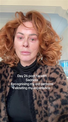 Emotional Healing Journey: Day 26 Post Facelift