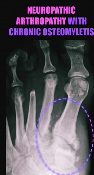Neuropathic Arthropathy with Chronic Osteomyelitis #shorts #diabetes #radiology