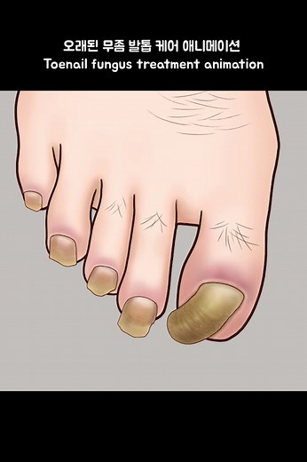 Toenail Fungus Treatment Animation