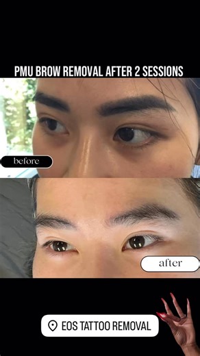 San Antonio Tattoo Removal Specialists on Instagram: "Thinking about removing your permanent eyebrows? We can help. Most brows don’t need as many treatments as regular tattoos. ✨ click the link in our bio to book your free consultation.##tattooremovalspecialists##tattooremoval##sanantoniotattooremoval##sanantonio##permanenteyebrowremoval"