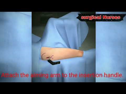 TFNA Naling System
