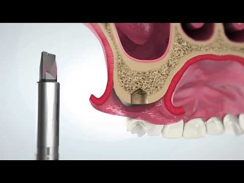 iRaise sinus lift system