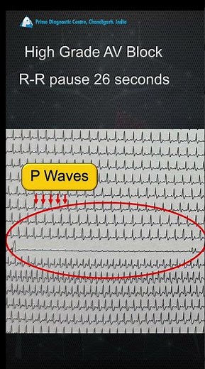 LBBB syncope. Think....