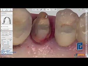 Corona anatómica 3shape desde scaner intraoral trios