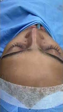 Rhinoplasty Flat Nose Surgery