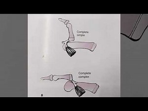 Metacarpophalangeal Dislocation of the Thumb | Closed Reduction Technique (Orthopedic Surgery)