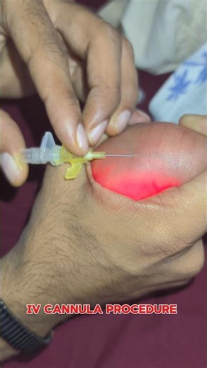iv cannula procedure || 24G cannula insertion 🩺🐥✨ #youtube #trending #viral #doctor #newborn