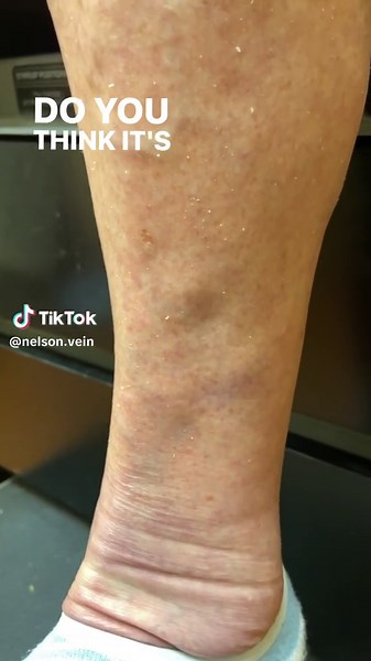 Muscle Fascia Defect vs. Varicose Vein: What's the Bulge in Your Leg?