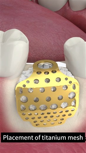 dentalmaster on Instagram: "✨ GBR Titanium Mesh in Immediate Implant Placement Combining implant placement and bone augmentation in one procedure — saving two surgical steps and significantly improving time efficiency and healing outcomes. ⏱️💪 #DentalImplant #GBR #TitaniumMesh #BoneAugmentation #ImmediateImplant #ImplantDentistry #OralSurgery #DentalMaster #Regeneration #DentistryInnovation #DentalTechnology #BoneGraft #ImplantSurgery #DentistLife #DentalCare"