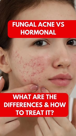 Is there a difference between fungal acne vs hormonal acne? These two types of acne have different causes, but share a common symptom of oily skin and clogged pores. Fungal acne treatments and OTC acne pills can help. Watch until the end for treatment recommendations. #fungalacnevsregularacne #fungalacneskincare #fungalacneproducts #fungalacnetreatment #fungalacnes #BeUnbxd
