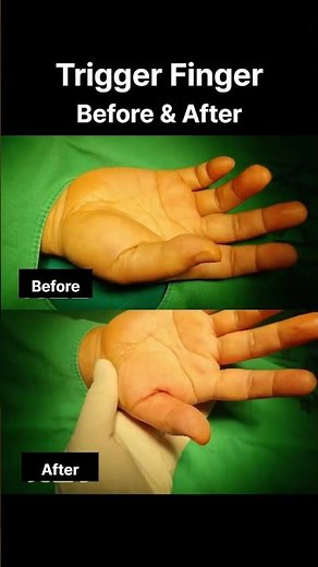 Stuck Thumb? Watch This Immediate Release. #triggerfinger #handsurgery #handpain