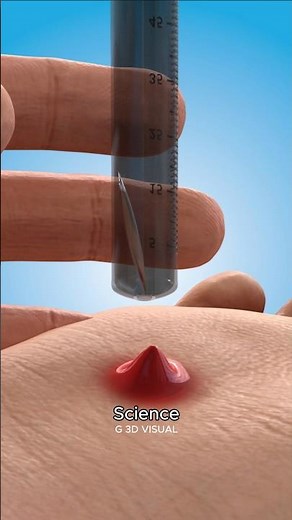 The Smart Way to Remove a Splinter Using Science!