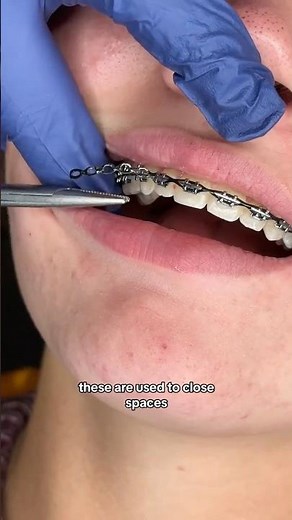 What are the different types of Orthodontic Ties?
