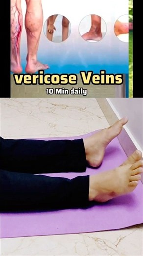 10-Min Daily Exercise for Varicose Veins Relief & Leg Circulation 🦵✨