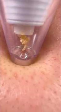 Best Blackhead Remover Tool: Pore Vacuum Extraction Demo & Review