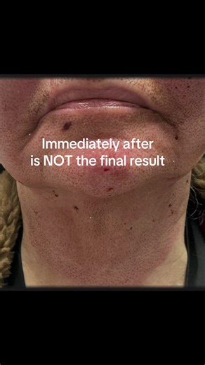 Plasma Pen results take patience This is why consults matter ✨ #plasmabypita #PlasmaPen #SkinTightening