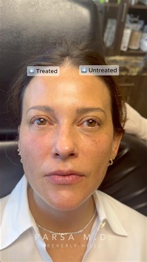 Bio Filler Results (Before & Immediately After)