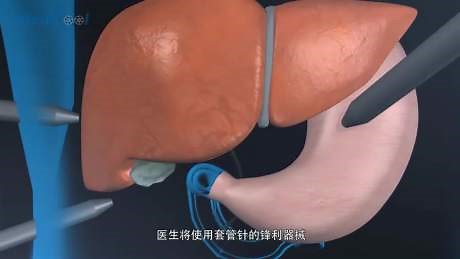 胆结石病人胆囊切除术全过程，腹腔镜微创手术