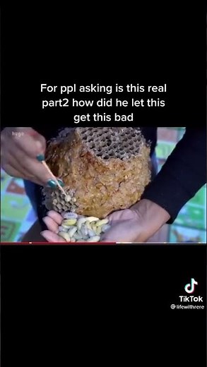 Part 2 of botfly removal from human head 🤯#botfly #larva #removal #infested