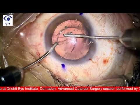 Live Cataract Surgery: Femto with Eyehance Toric IOL by Dr. Gaurav Luthra