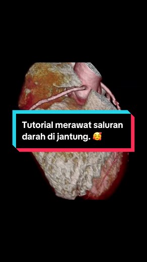 Tutorial Merawat Saluran Darah Sempit dengan Stent