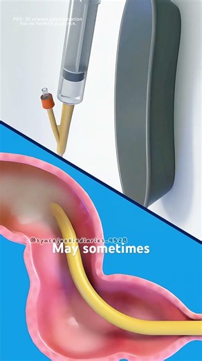 How enema therapy cleans your colon instantly (3D animation) #motivation #healthyroutine #feelbetter