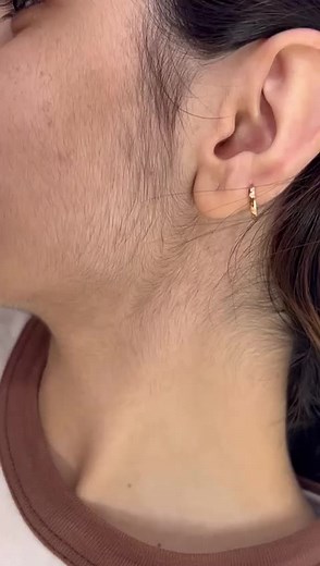 İlk seansdan nəticə👍👍#arzulazer #haziaslanov #diodebuzlazerepilasyon #buzlazer #lazer