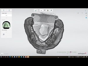 Lower Cast Partial Denture Design