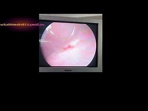 Dr Bimalesh Purkait: TURBT / Bladder Tumor Resection