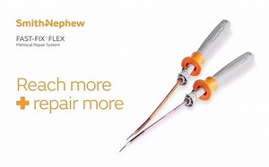 半月板缝合器-V1-FAST-FIX-FLEX-Posterior Vertical Tear Repair -0621