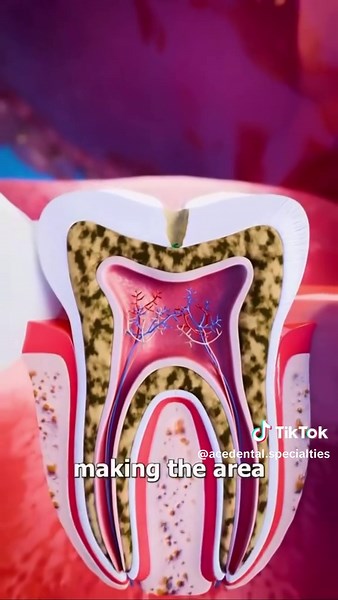 🦷⚠️ From a Small Cavity to a Serious Tooth Infection — Don’t Wait! At Ace Dental Specialties, we often see how a small, untreated cavity can turn into a painful infection requiring a root canal. 💡 Here’s how it happens: 1️⃣ Early cavity (enamel) Plaque bacteria begin damaging the outer layer of your tooth — often with no pain. 2️⃣ Deeper decay (dentin) The cavity grows deeper, causing sensitivity to hot, cold, or sweets. 3️⃣ Infection reaches the pulp Bacteria reach the inner nerve (pulp), lea