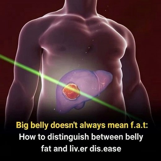 41K views · 30 reactions | Not all big bellies are caused by f.a.t — here’s how to distinguish belly f.a.t from liver disease | Blog BNews TV | Facebook