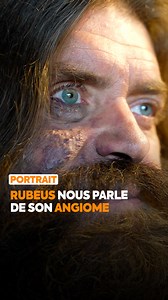 Le forgeron Rubeus (Rubeus Créations) nous raconte comment son angiome a façonné son parcours et contribué à faire de lui l’homme qu’il est aujourd’hui ⚒️✨ | Neo