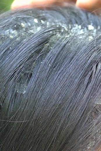 Extreme Dandruff | 33K